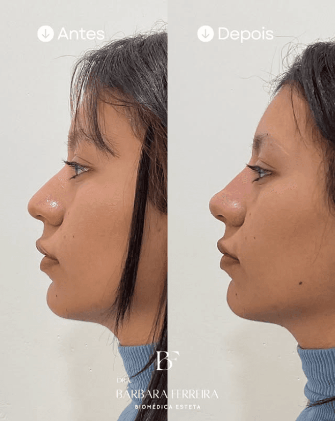 Rinomodelação - Dra. Bárbara Ferreira, Biomédica Esteta
