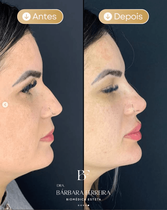 Rinomodelação - Dra. Bárbara Ferreira, Biomédica Esteta