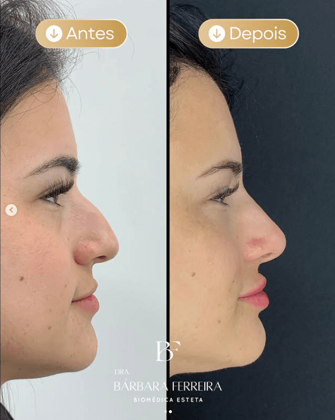 Rinomodelação Masculina - Dra. Bárbara Ferreira, Biomédica Esteta