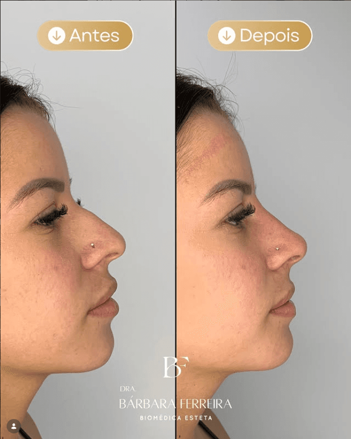 Rinomodelação - Dra. Bárbara Ferreira, Biomédica Esteta