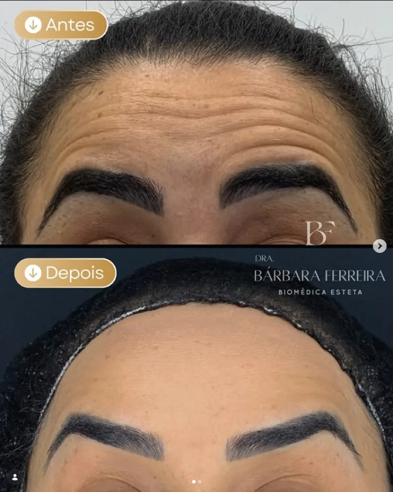 Resultado de botox — antes e depois