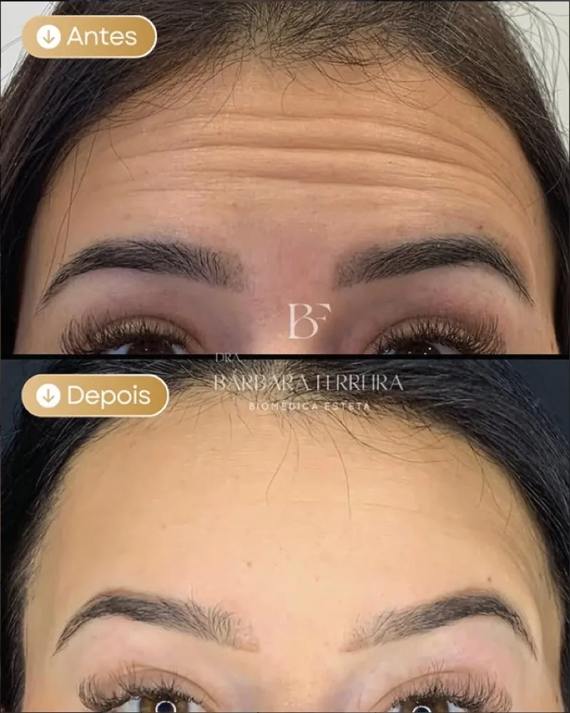 Resultado de botox — antes e depois