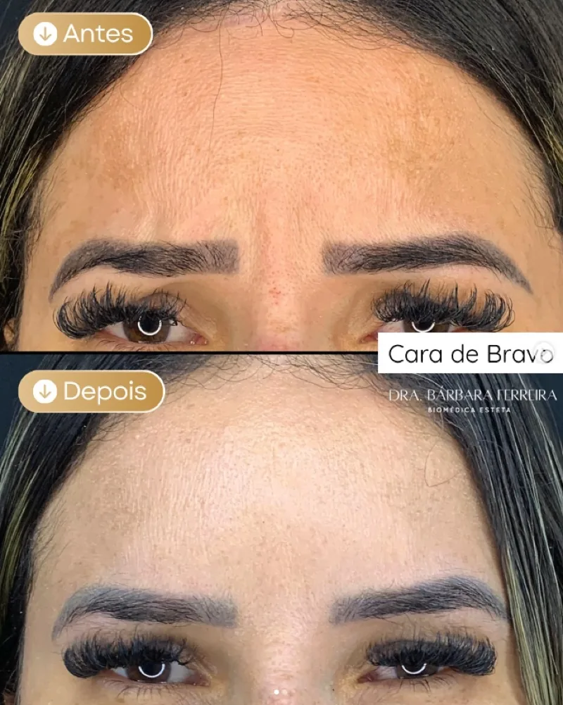 Resultado de botox — antes e depois