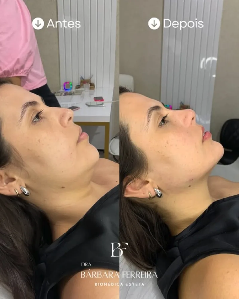 Resultado de harmonização facial — antes e depois
