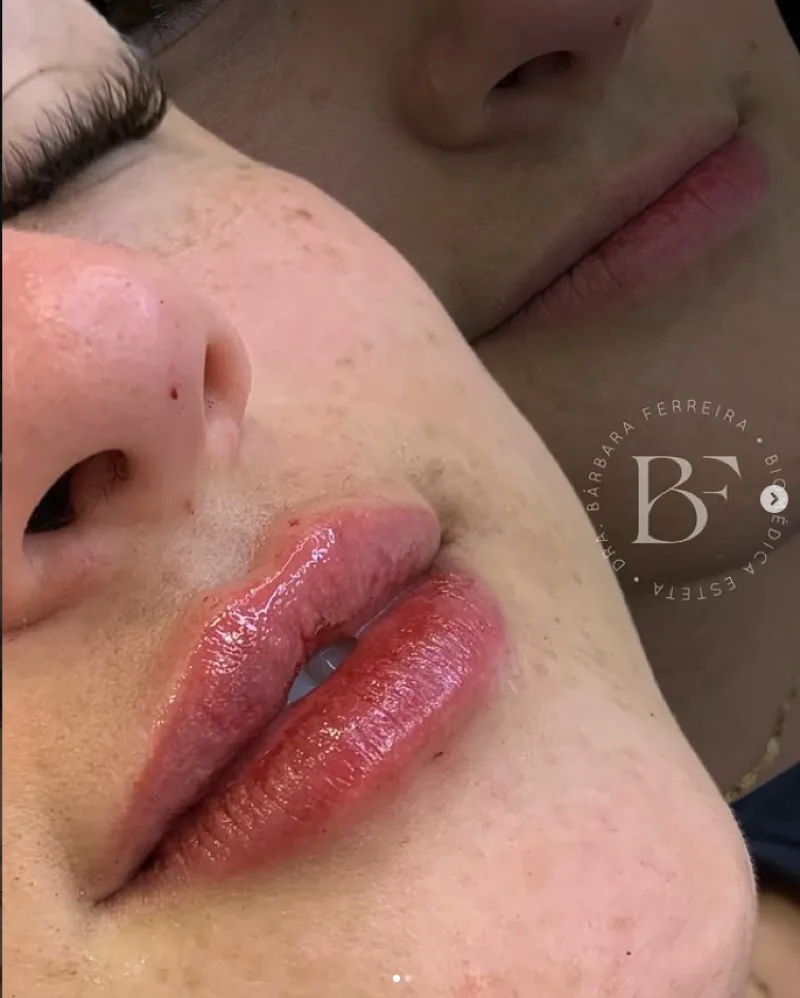 Resultado de preenchimento labial — antes e depois