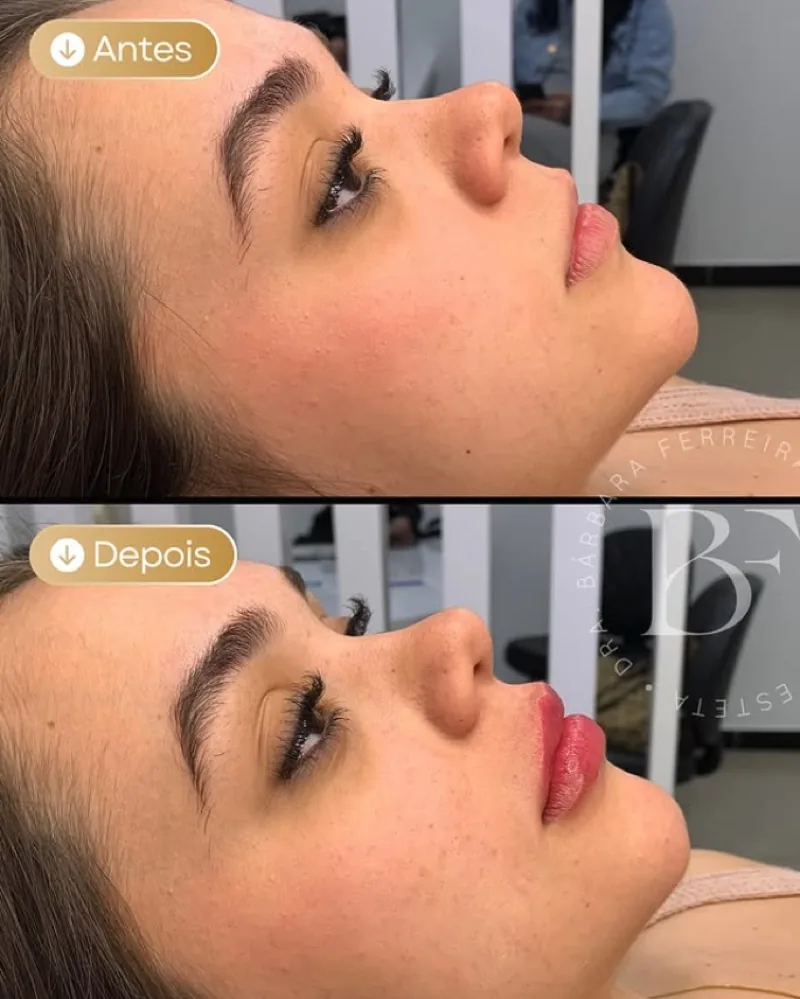 Resultado de preenchimento labial — antes e depois