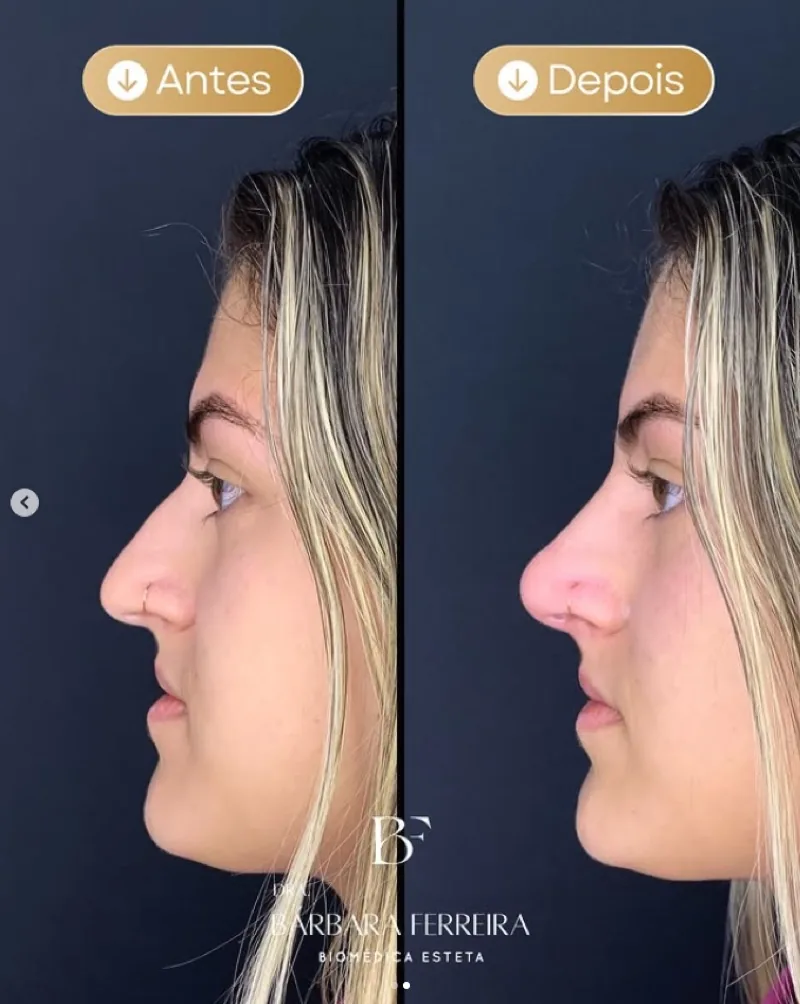 Resultado de rinomodelação — antes e depois