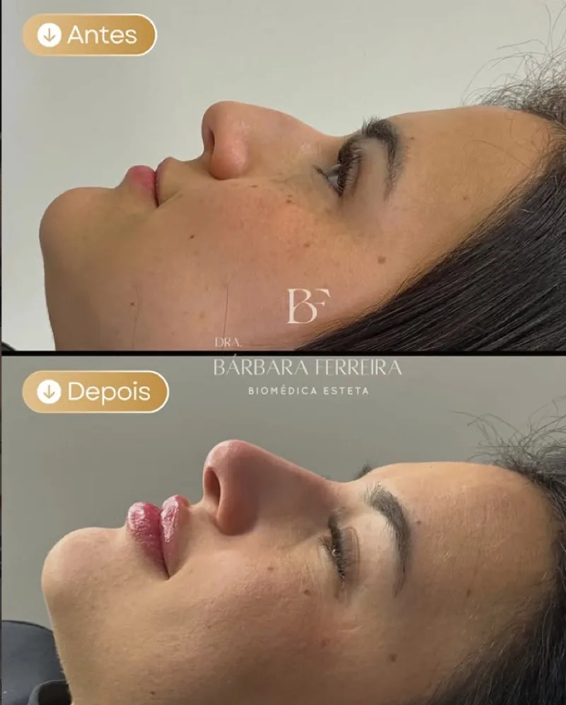 Resultado de rinomodelação — antes e depois