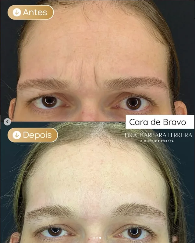 Resultado de toxina botulínica na glabela — antes e depois
