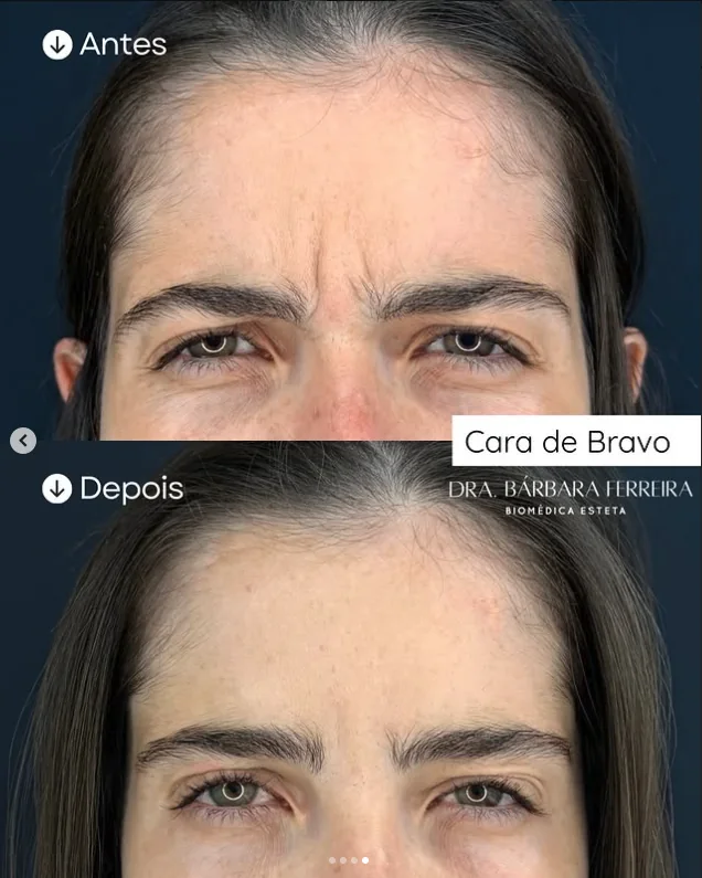 Resultado de toxina botulínica na glabela — antes e depois