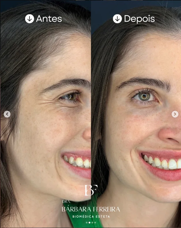 Resultado de toxina botulínica em linhas de expressão — antes e depois