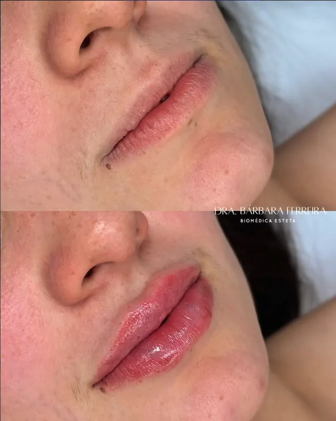 Resultado de preenchimento labial — antes e depois